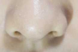 鼻子兩側擠出來的白色條狀物，是什麼東西？真的會越擠越多嗎？