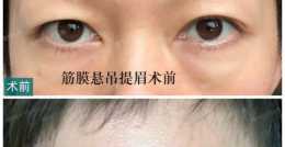 北京眼周年輕化醫生代禮先：眼周年輕化手術包括哪些？眼周年輕化都有什麼專案？醫生最全總結