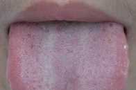 舌苔增厚，發白發黃是否正常，正常舌苔是怎麼樣的