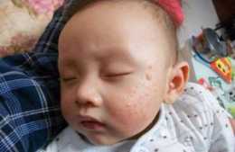 嬰兒溼疹發生原因及日常家庭護理