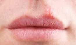 唇周邊長痘怎麼辦 正確護理肌膚的方法