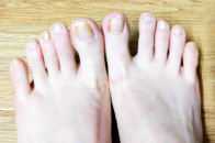 灰指甲真的很難治癒嗎？腳上的會傳染到手上嗎